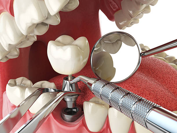 Best Emergency Denture Repair in North Key Largo, FL